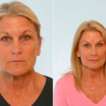 Blepharoplasty before and after photos in Houston, TX, Patient 26535