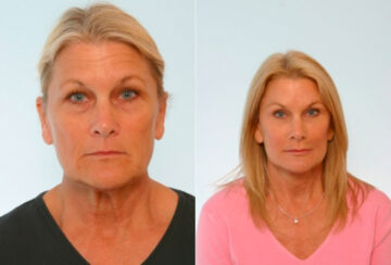 Blepharoplasty before and after photos in Houston, TX, Patient 26535