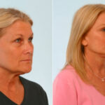 Blepharoplasty before and after photos in Houston, TX, Patient 26535