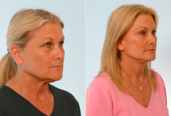 Blepharoplasty before and after photos in Houston, TX, Patient 26535