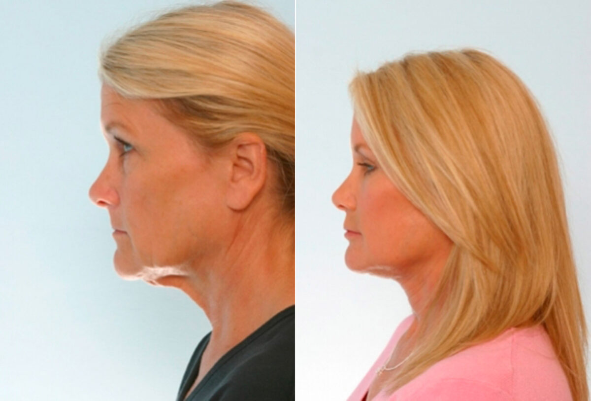 Blepharoplasty before and after photos in Houston, TX, Patient 26535