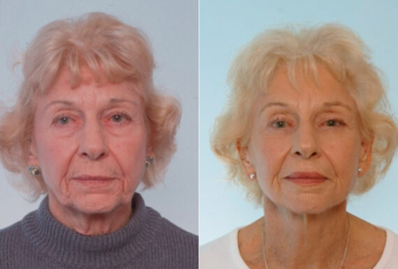 Blepharoplasty before and after photos in Houston, TX, Patient 26542