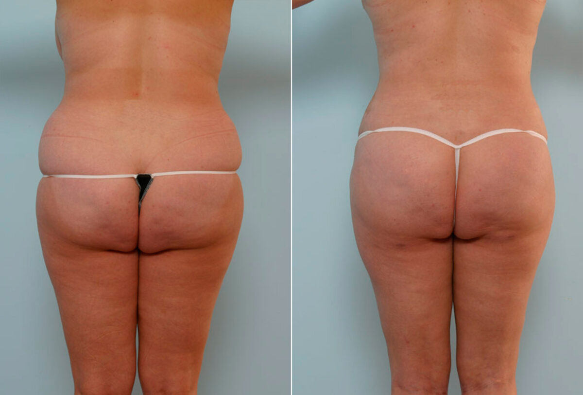 Abdominoplasty before and after photos in Houston, TX, Patient 24428