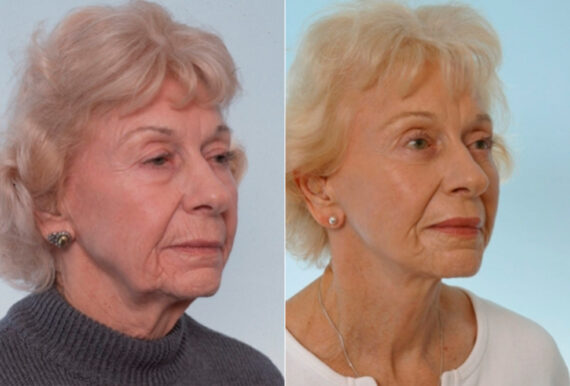 Blepharoplasty before and after photos in Houston, TX, Patient 26542