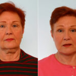 Blepharoplasty before and after photos in Houston, TX, Patient 26547