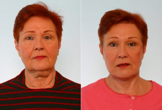 Blepharoplasty before and after photos in Houston, TX, Patient 26547