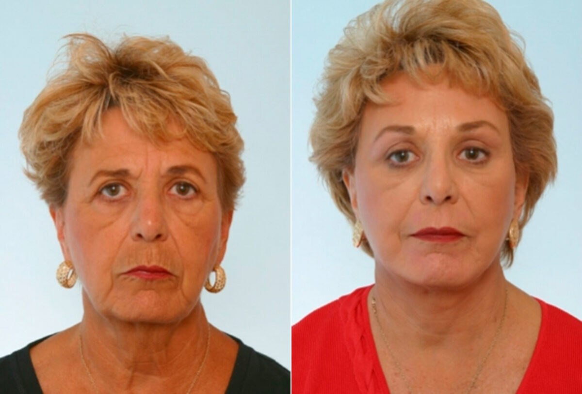 Blepharoplasty before and after photos in Houston, TX, Patient 26554