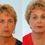 Blepharoplasty before and after photos in Houston, TX, Patient 26554