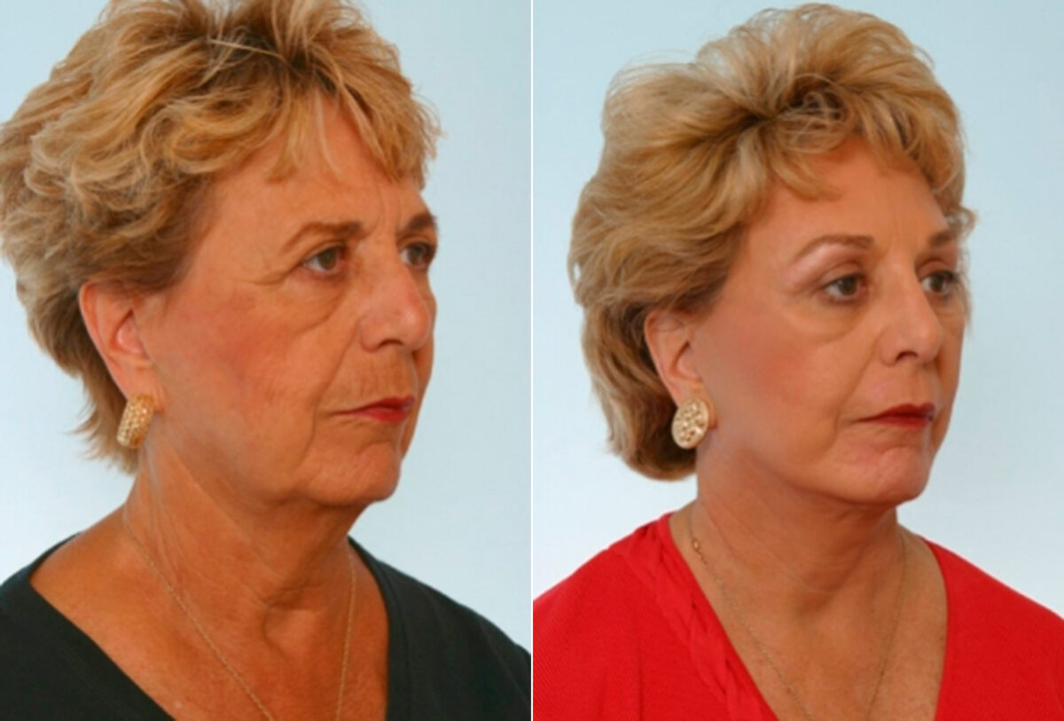 Blepharoplasty before and after photos in Houston, TX, Patient 26554