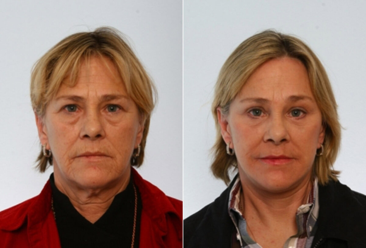 Blepharoplasty before and after photos in Houston, TX, Patient 26561