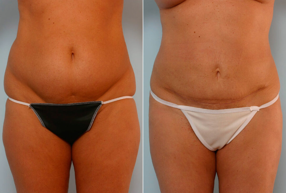 Abdominoplasty before and after photos in Houston, TX, Patient 24438
