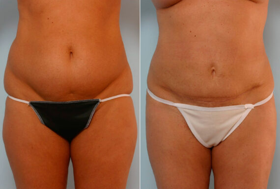 Tummy Tuck/Abdominoplasty before and after photos in Houston, TX, Patient 24438