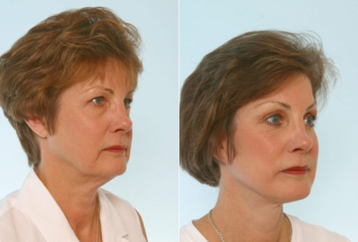 Blepharoplasty before and after photos in Houston, TX, Patient 26568