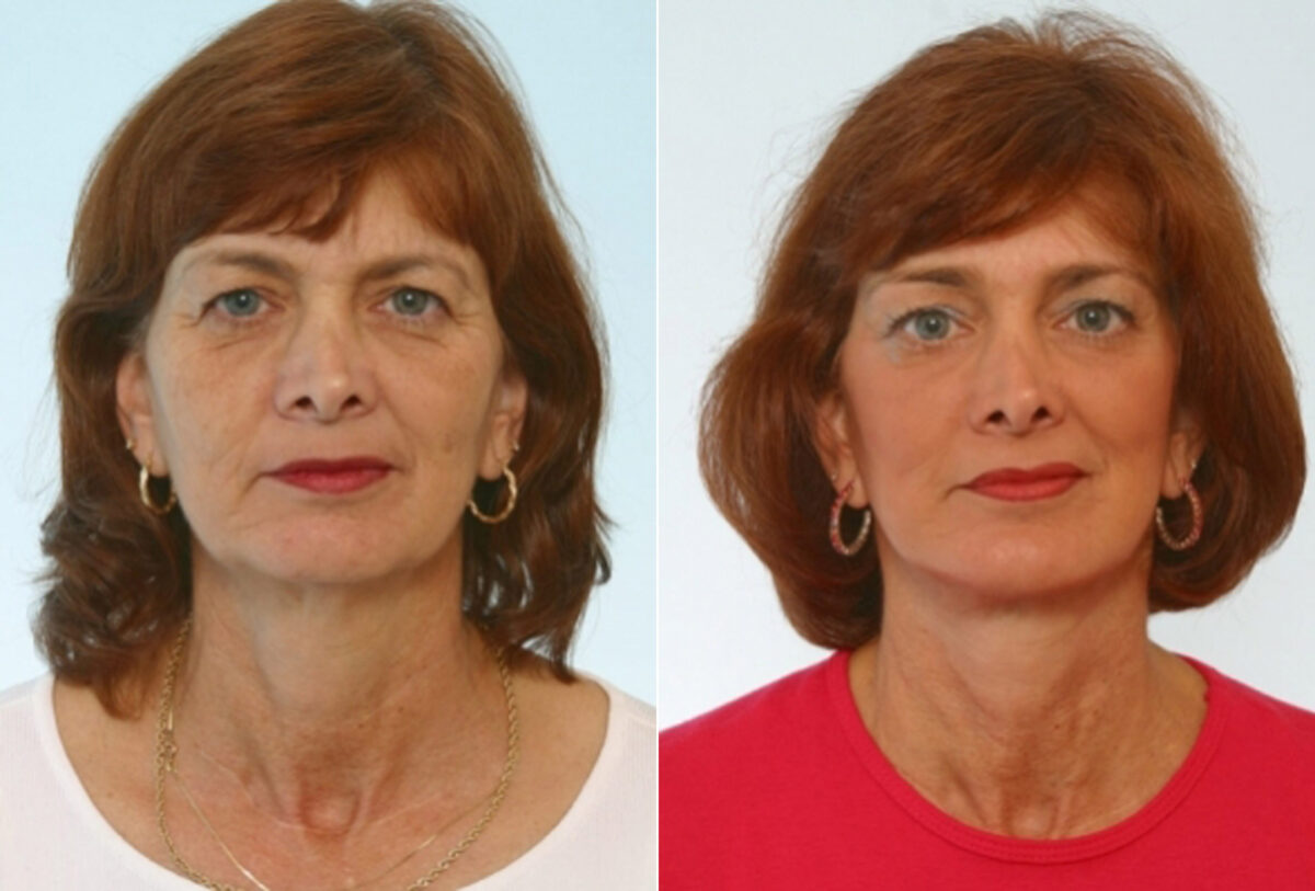 Blepharoplasty before and after photos in Houston, TX, Patient 26575