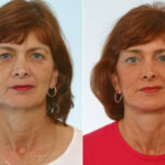 Blepharoplasty before and after photos in Houston, TX, Patient 26575