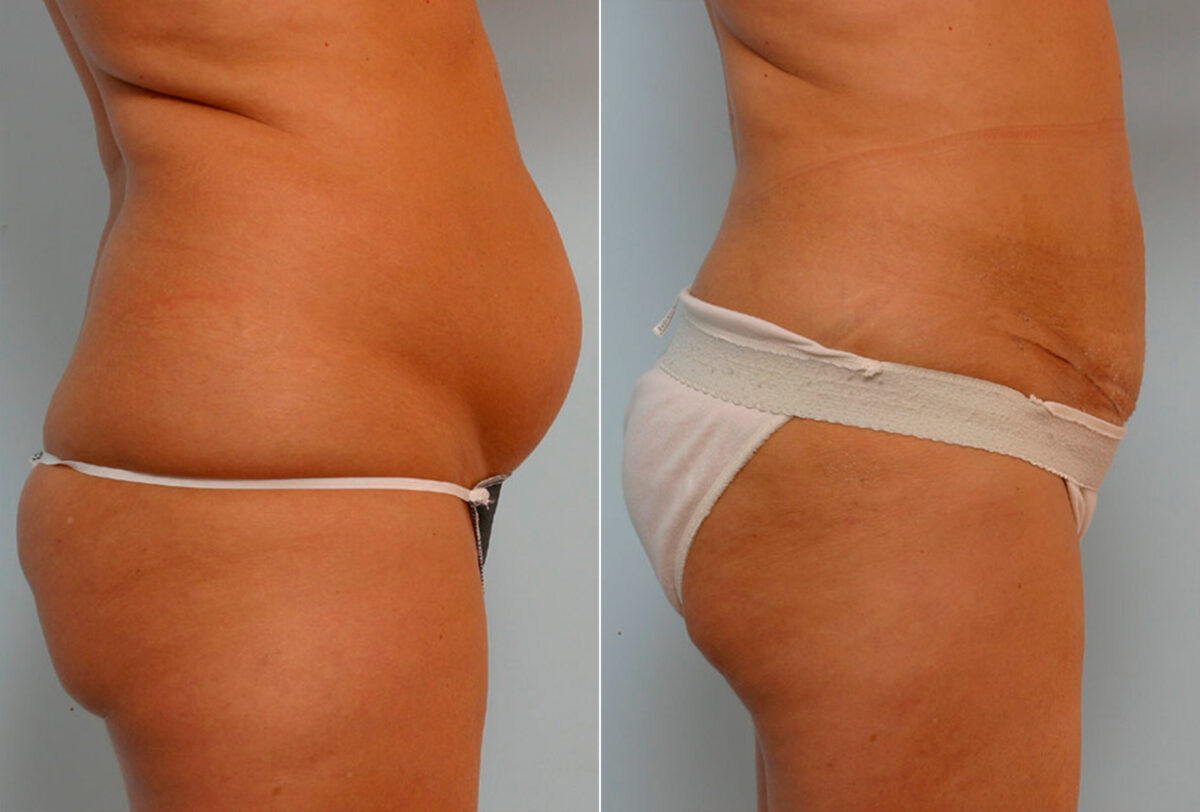 Abdominoplasty before and after photos in Houston, TX, Patient 24438