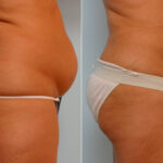 Abdominoplasty before and after photos in Houston, TX, Patient 24438