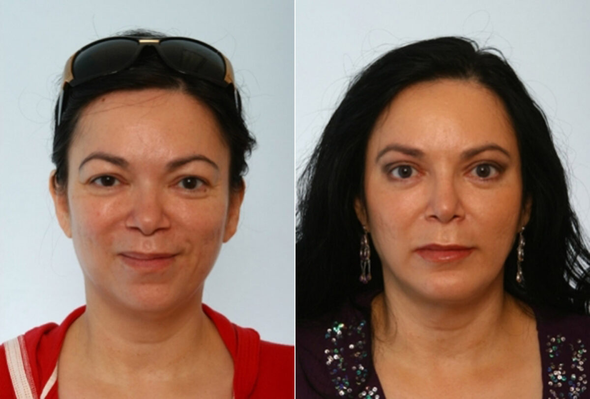 Blepharoplasty before and after photos in Houston, TX, Patient 26596