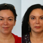 Blepharoplasty before and after photos in Houston, TX, Patient 26596