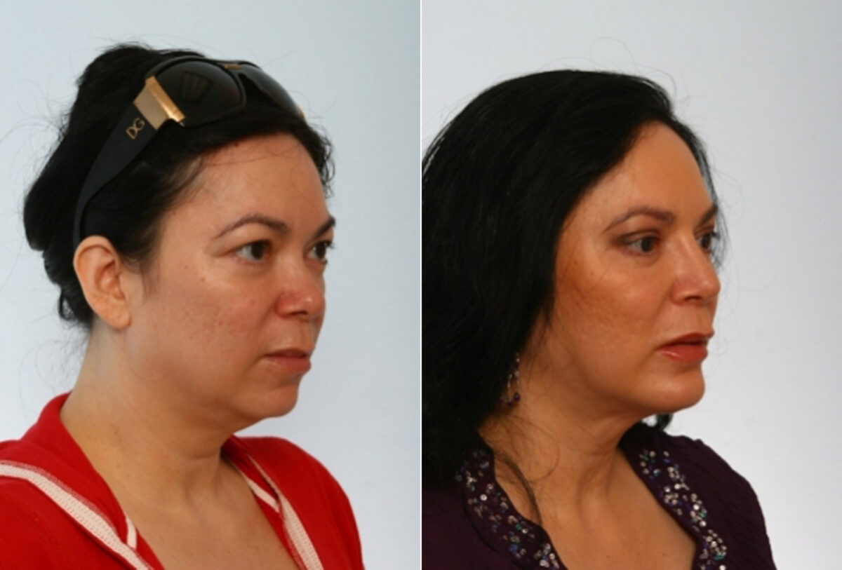 Blepharoplasty before and after photos in Houston, TX, Patient 26596