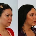Blepharoplasty before and after photos in Houston, TX, Patient 26596