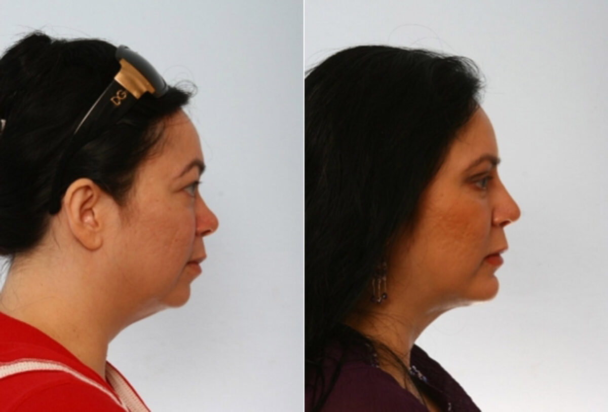 Blepharoplasty before and after photos in Houston, TX, Patient 26596