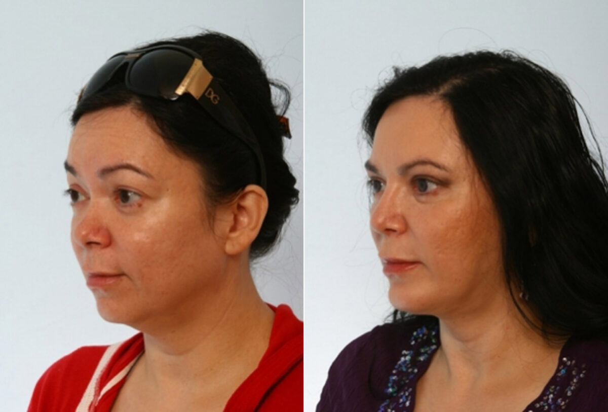 Blepharoplasty before and after photos in Houston, TX, Patient 26596