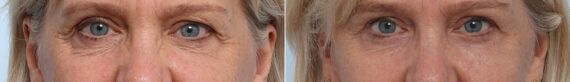 Blepharoplasty before and after photos in Houston, TX, Patient 26610