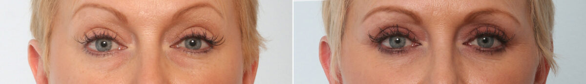 Blepharoplasty before and after photos in Houston, TX, Patient 26619