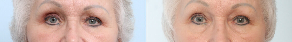 Patient 26643, Blepharoplasty before and after photos Blepharoplasty before and after photos in Houston, TX, Patient 26643
