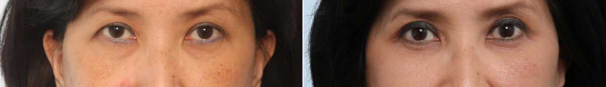Patient 26646, Blepharoplasty before and after photos Blepharoplasty before and after photos in Houston, TX, Patient 26646