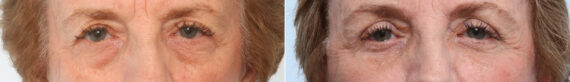 Blepharoplasty before and after photos in Houston, TX, Patient 26649