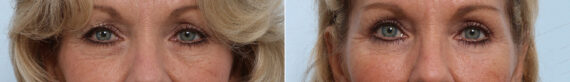 Blepharoplasty before and after photos in Houston, TX, Patient 26667