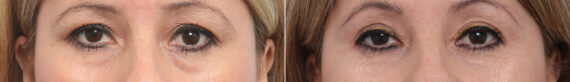 Blepharoplasty before and after photos in Houston, TX, Patient 26670