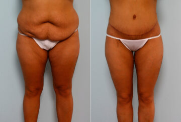 Body Lift before and after photos in Houston, TX, Patient 26673