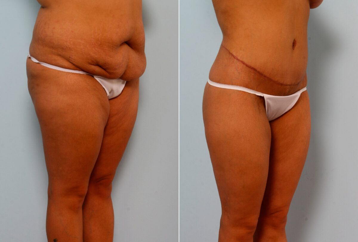 Body Lift before and after photos in Houston, TX, Patient 26673