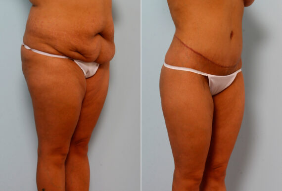 Body Lift before and after photos in Houston, TX, Patient 26673