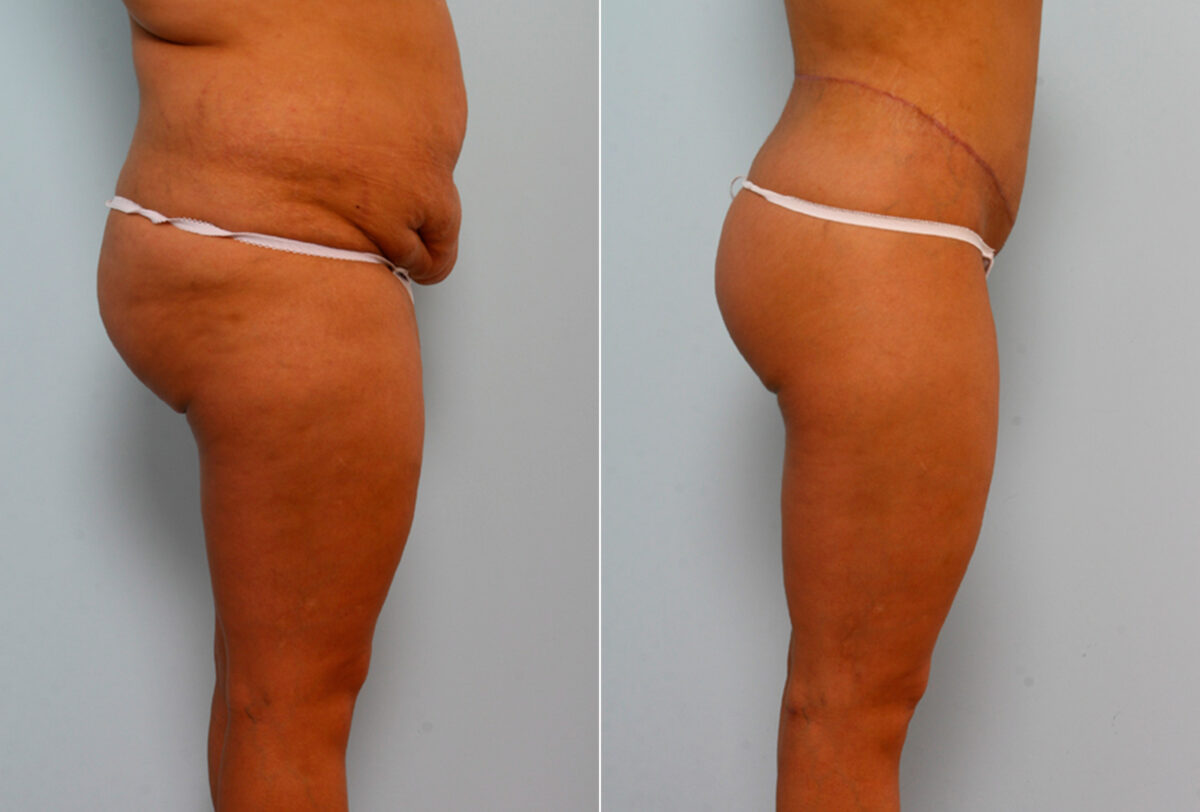 Body Lift before and after photos in Houston, TX, Patient 26673