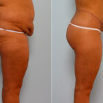 Body Lift before and after photos in Houston, TX, Patient 26673