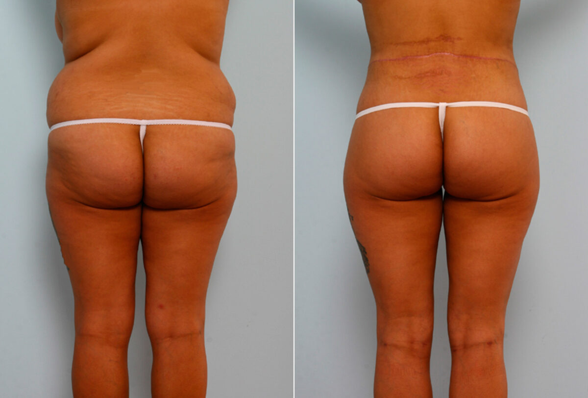 Body Lift before and after photos in Houston, TX, Patient 26673