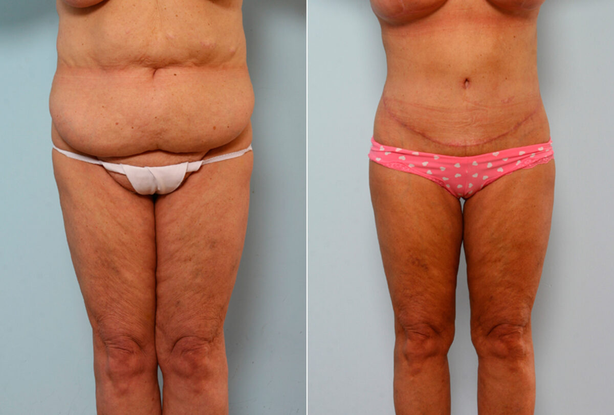 Body Lift before and after photos in Houston, TX, Patient 26682