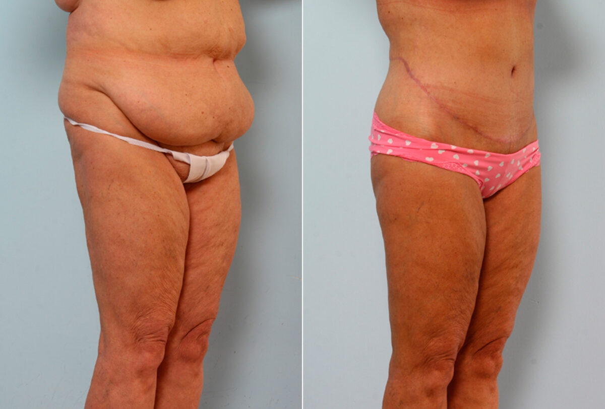 Body Lift before and after photos in Houston, TX, Patient 26682