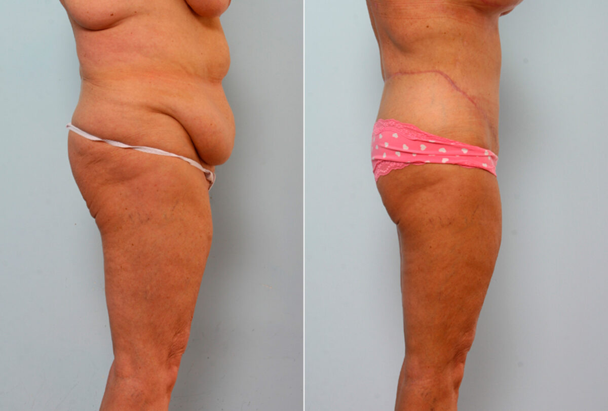 Body Lift before and after photos in Houston, TX, Patient 26682