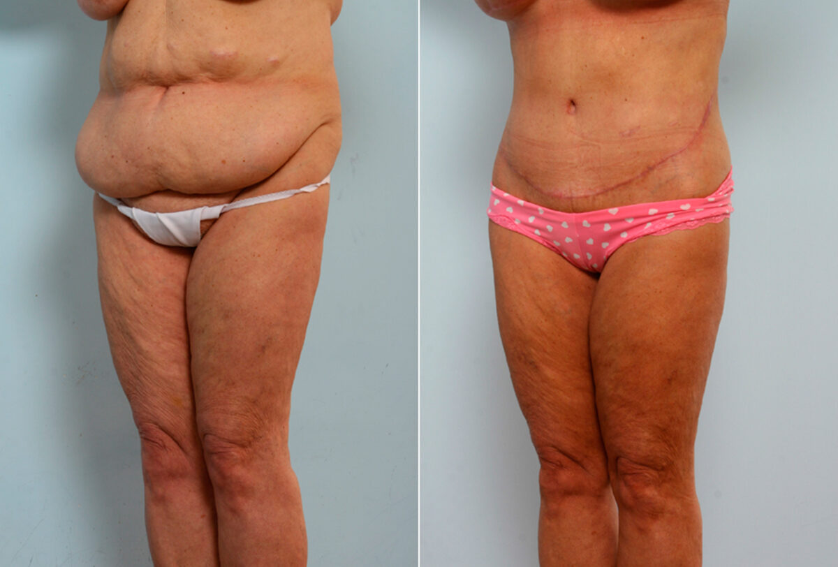 Body Lift before and after photos in Houston, TX, Patient 26682