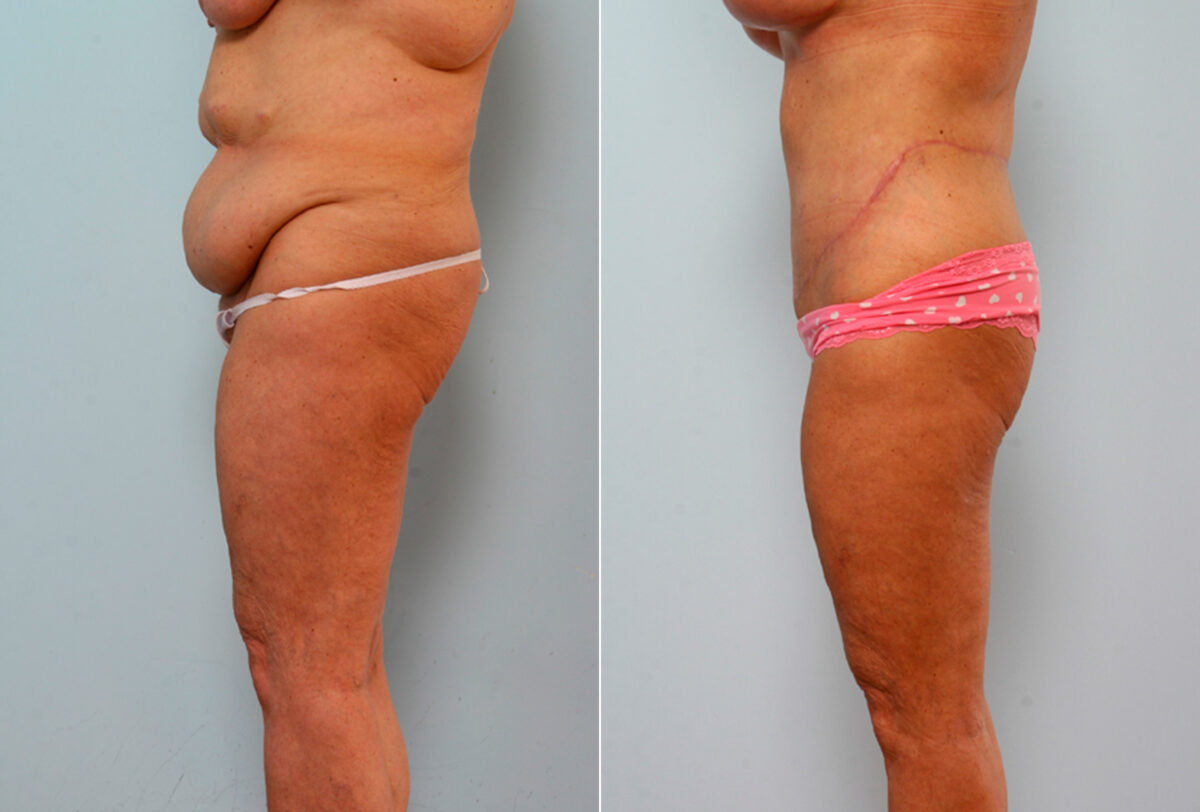 Body Lift before and after photos in Houston, TX, Patient 26682