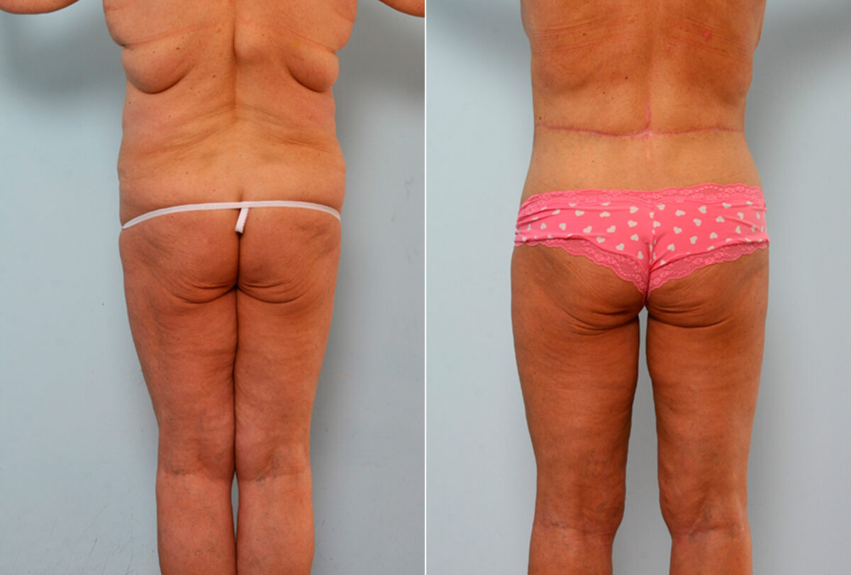 Body Lift before and after photos in Houston, TX, Patient 26682