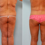 Body Lift before and after photos in Houston, TX, Patient 26682
