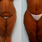 Body Lift before and after photos in Houston, TX, Patient 26695