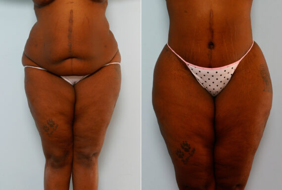 Body Lift before and after photos in Houston, TX, Patient 26695