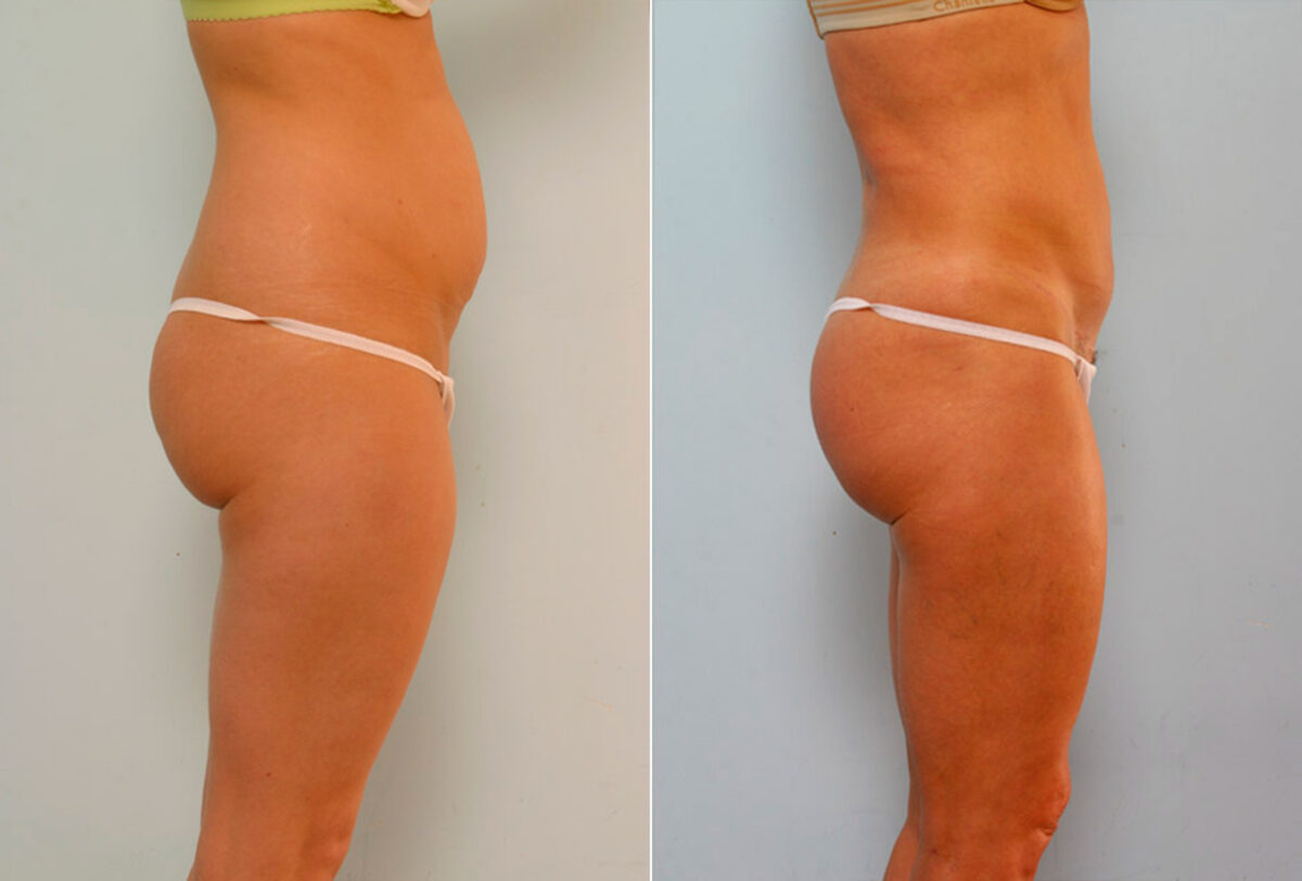 Tummy Tuck/Abdominoplasty before and after photos in Houston, TX, Patient 24219